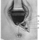 Image for article titled A Brief History Of Vaginal Cutting During Childbirth
